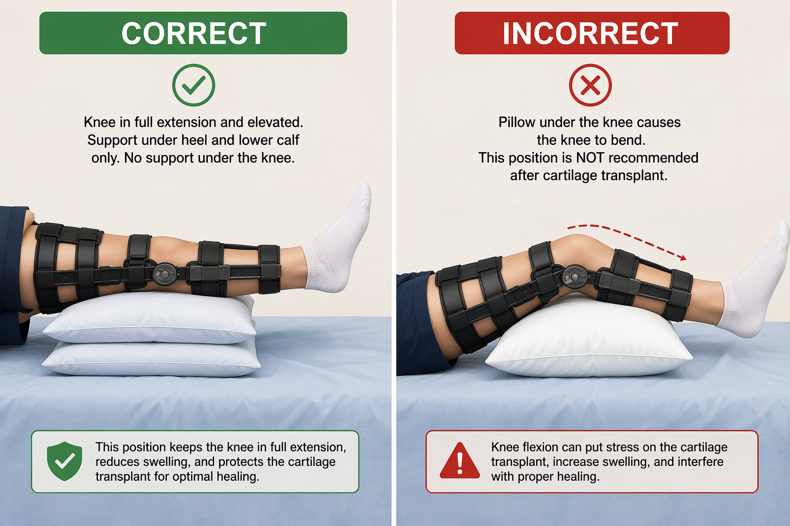 Medical comparison showing correct heel-supported leg elevation in a locked knee brace and incorrect pillow placement under the knee